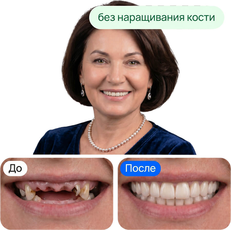 Все зубы на 6 имплантах, бездесневой протез