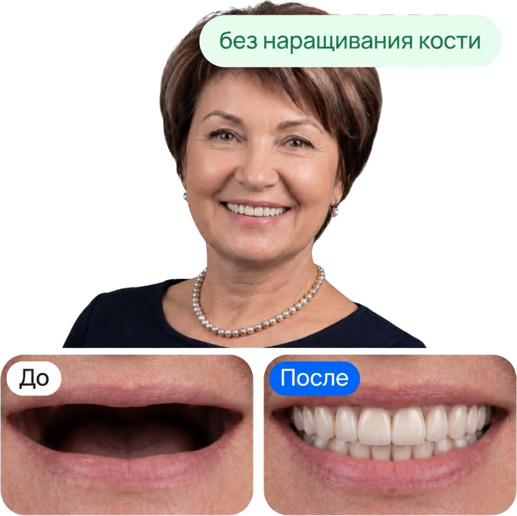 Все зубы на 4 имплантах, классический протез